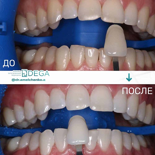 Профессиональное отбеливание зубов с использованием системы ZOOM4
